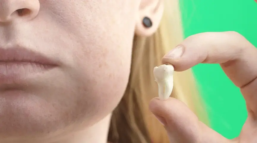 Steps to Follow After Tooth Extractions