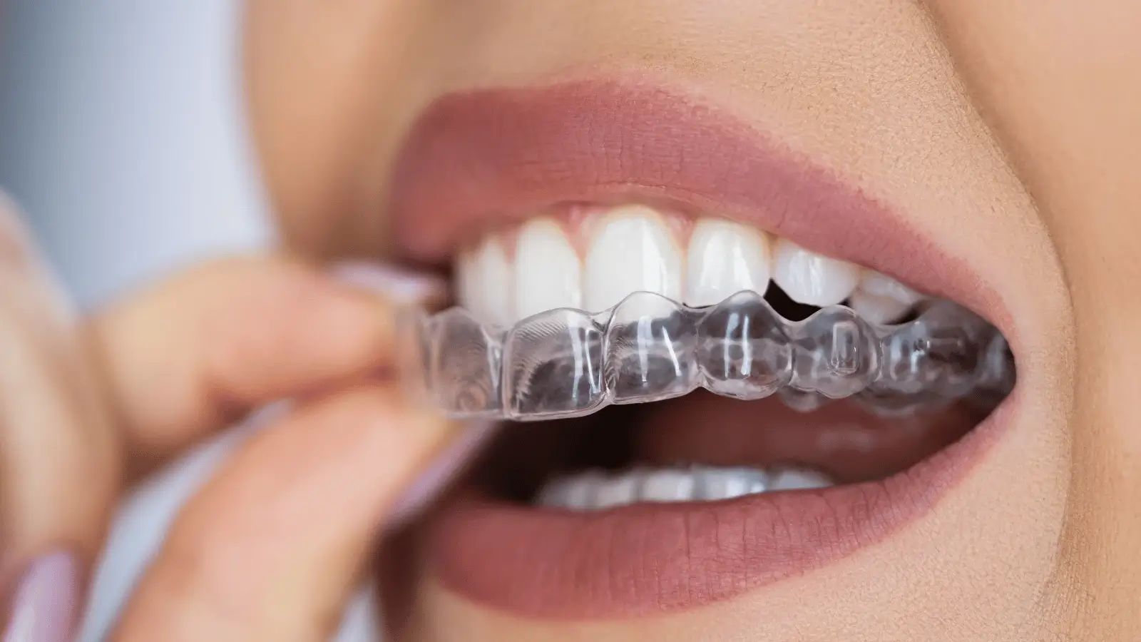 Straight Teeth with Clear Aligners