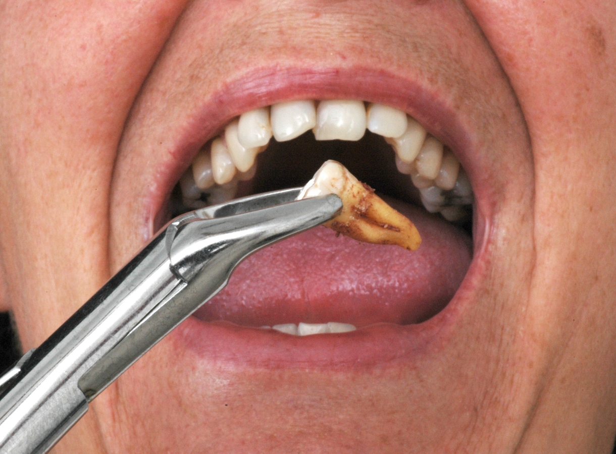 How Do I Know If I Need a Tooth Extraction