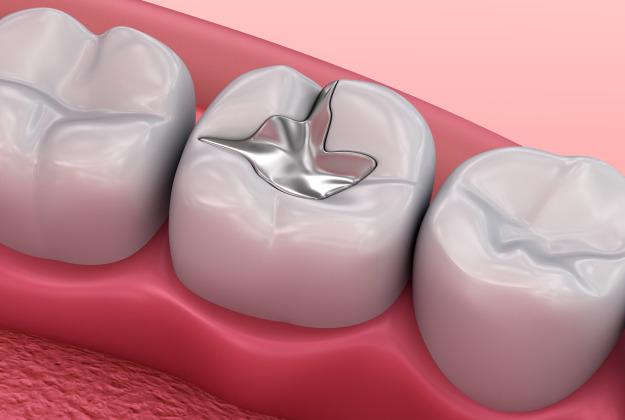 Dental filling services at Thrive Family Dentistry of Auburn AL for healthy confident smiles