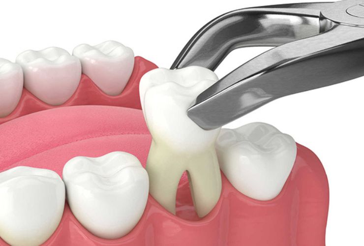 Damaged tooth extractions at Thrive Family Dentistry in Auburn, Alabama